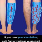 Thrombosis: What It Is, How to Identify Its Symptoms, and Prevent It Naturally