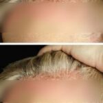How to get rid of inner ear crystals and reduce vertigo