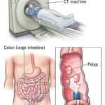 This natural and effective remedy for relieving constipation